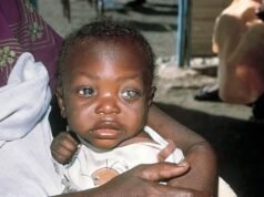 Why Child Blindness Is Increasing in Jigawa State