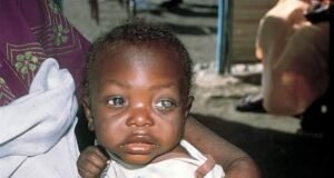 Why Child Blindness Is Increasing in Jigawa State