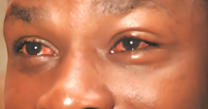 Conjunctivitis-apollo
